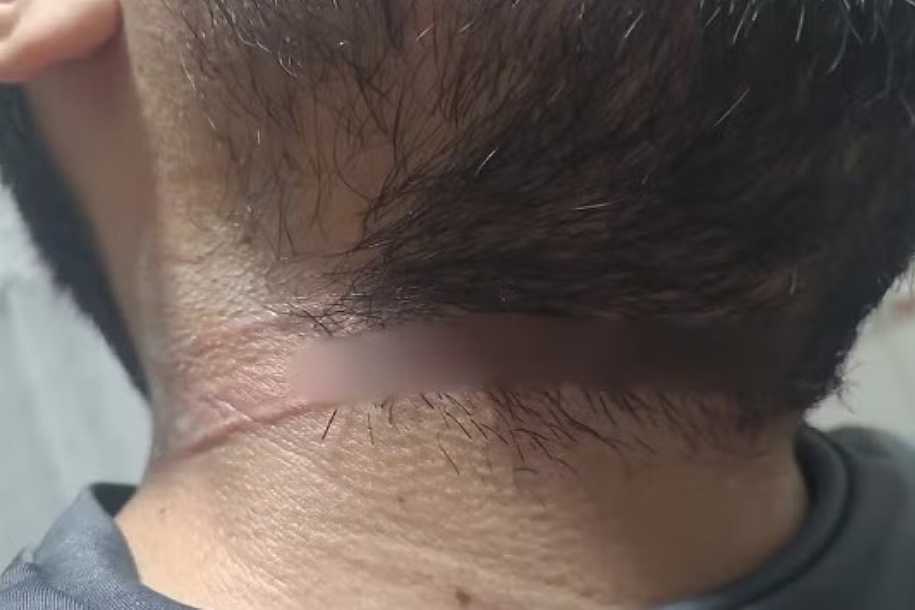 Motociclista tem pescoço e mão cortados por linha de pipa com cerol em Monte Aprazível