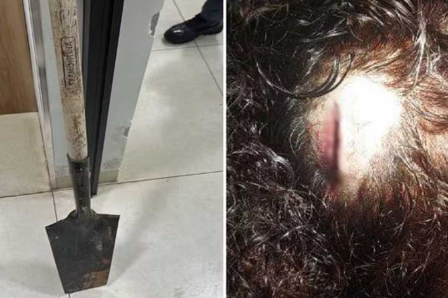 Mulher tem dedo quebrado e sofre cortes na cabeça após ser agredida com pá por homem