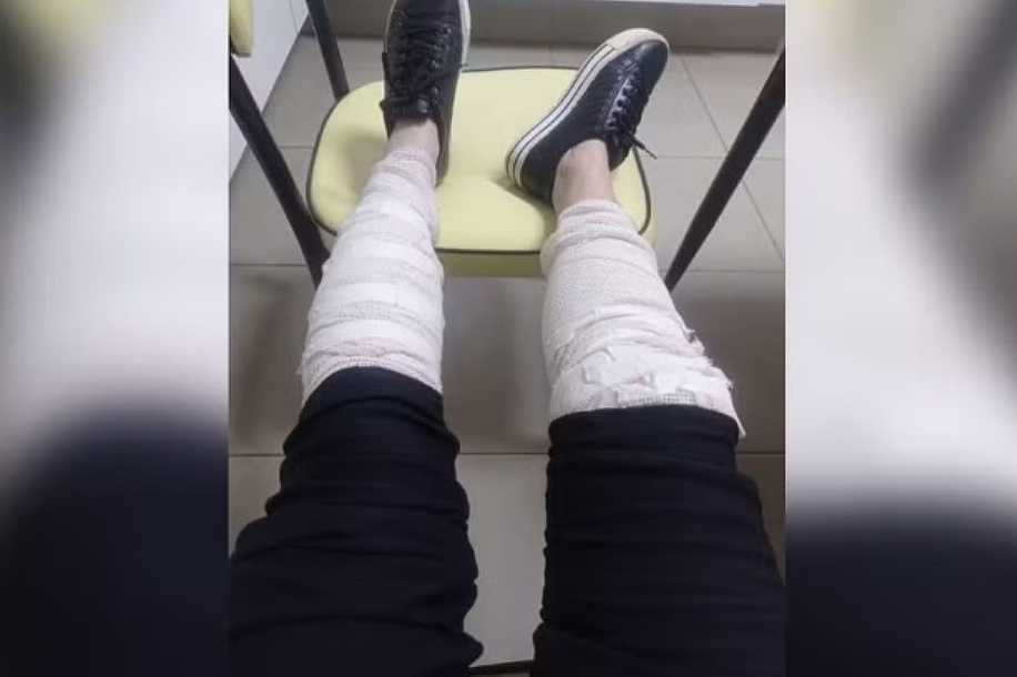 Enfermeira é afastada após ser atacada por cães em semáforo no interior de São Paulo
