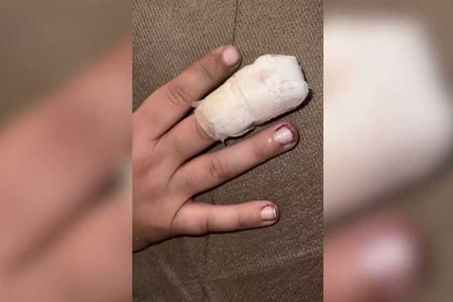 Mãe alega que menino teve dedo esmagado por colegas dentro de escola pública no interior de SP: ´Poderia ter perdido a mão´