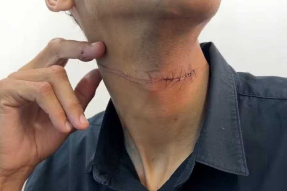 Motociclista recebe pontos no pescoço ao ser atingido por linha chilena no interior de SP