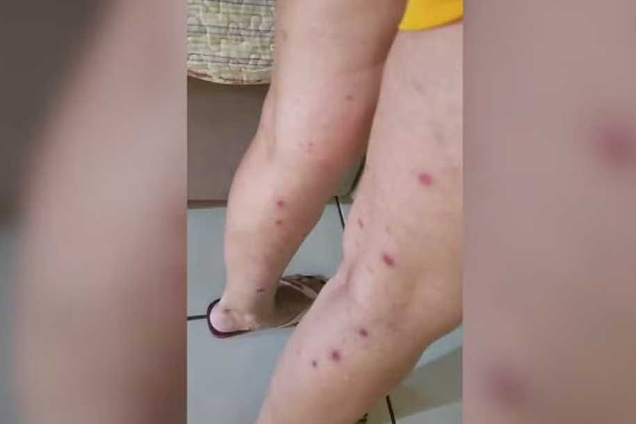 Auxiliar relata coceira intensa e noites sem dormir após surto de sarna humana em creches: ´É insuportável´