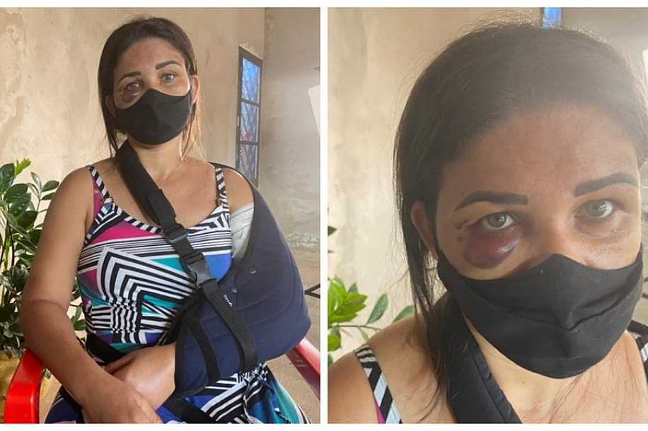 Funcionária de padaria tem braço quebrado por cliente após pedir para homem usar máscara contra a Covid