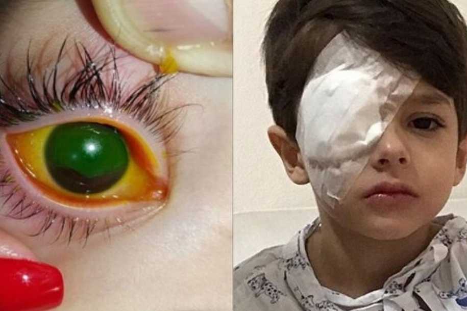 Garoto de cinco anos tem a córnea queimada em acidente com álcool em gel