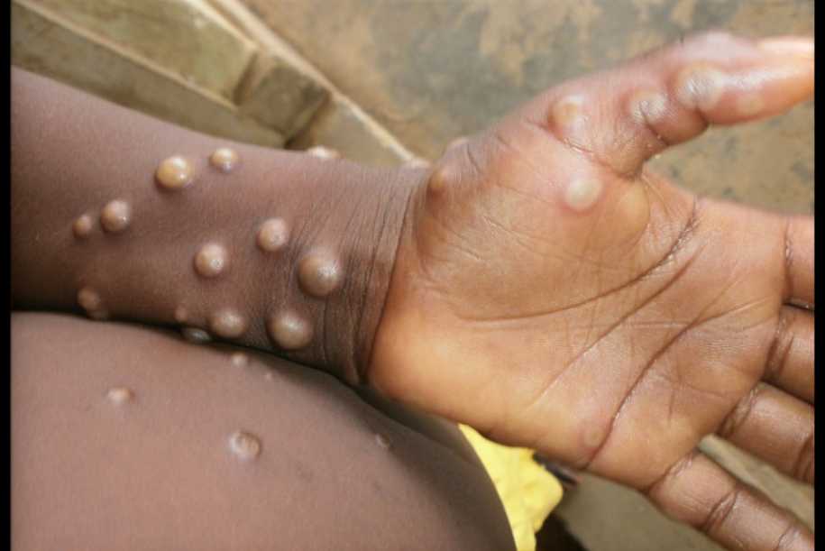 Monkeypox: infecção causada por vírus não é ´varíola dos macacos´, diz especialista