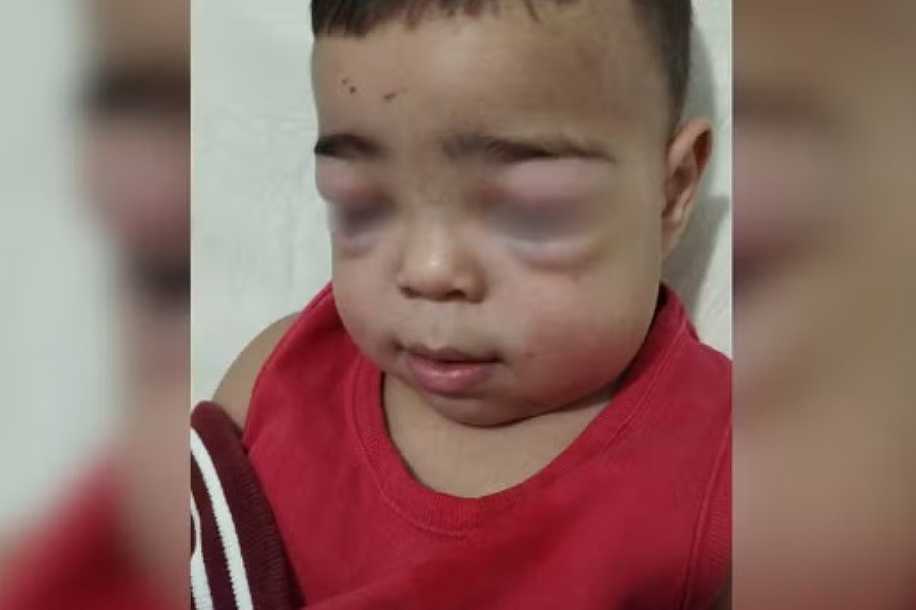 Pais denunciam profissional por colocar sem testar sonda urinária que ficou ´travada´ na bexiga de criança de 2 anos