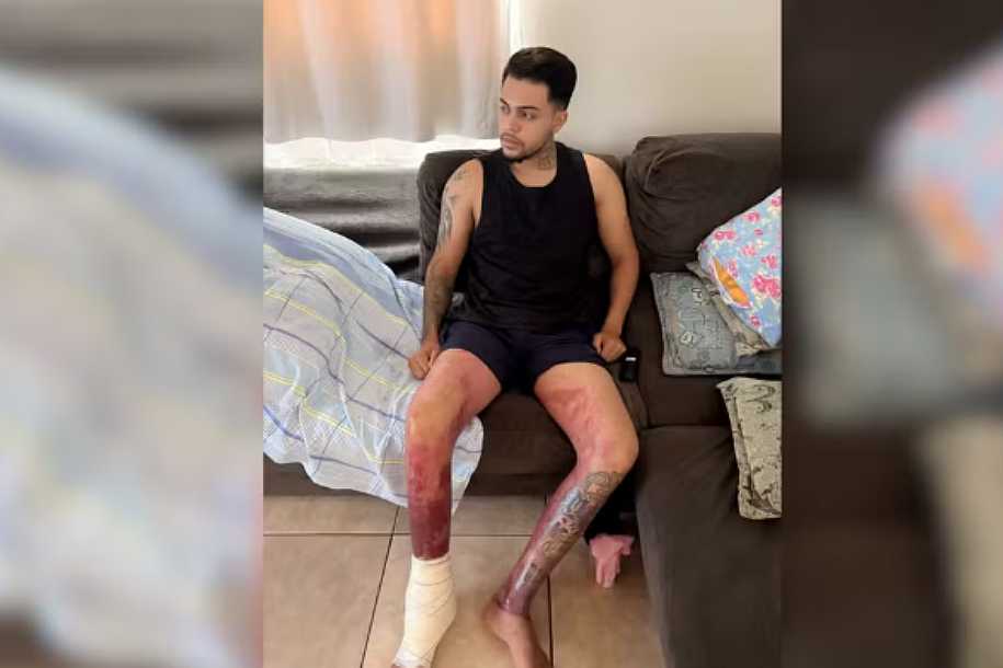 Jovem que teve queimaduras após explosão causada por etanol em tacho recebe alta de hospital: ´Tempo de recuperação´