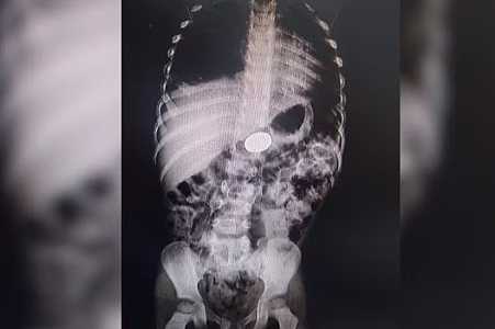 Pais buscam ajuda médica após criança ficar dez dias com moeda presa no estômago