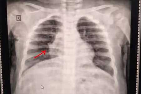 Bebê com pneumonia e dependente de oxigênio nasal espera vaga em hospital há 4 dias: ´Não aguento mais ver ela sofrer´, lamenta mãe
