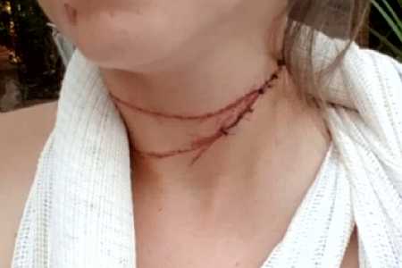 Motociclista fica ferida após ser atingida por linha com cerol em Santa Fé do Sul