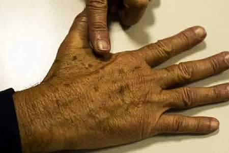 Câncer de pele gera R$ 4,6 mi em custos hospitalares em quase 2 anos