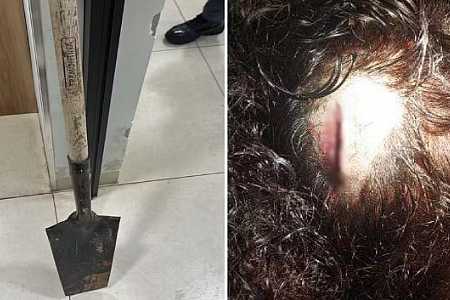 Mulher tem dedo quebrado e sofre cortes na cabeça após ser agredida com pá por homem