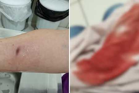 Comerciante fica ferida após ser mordida por cachorro em Jales