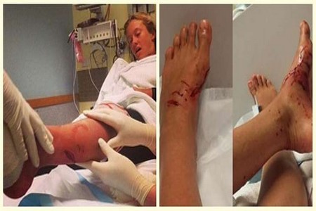Surfista de 13 anos escapa de ataque de tubarão na Austrália