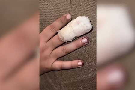 Mãe alega que menino teve dedo esmagado por colegas dentro de escola pública no interior de SP: ´Poderia ter perdido a mão´