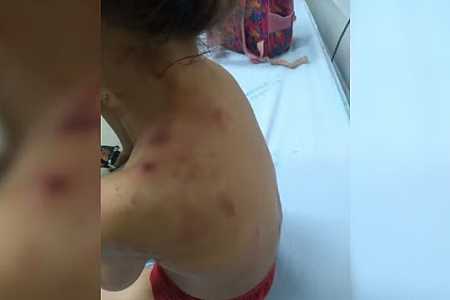 Crianças ficam feridas após serem atacadas por pit bulls no interior de SP