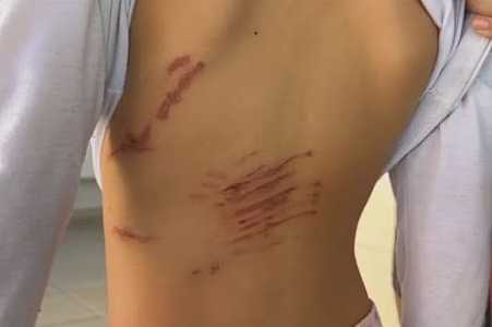 Pai de crianças que ficaram feridas após serem mordidas por pit bulls diz que os ataques são recorrentes