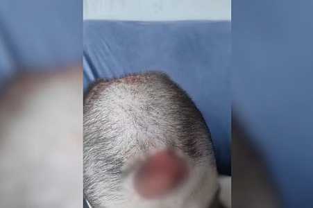 Adolescente autista com ferida exposta na cabeça aguarda cirurgia há 19 dias no interior de SP