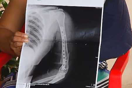 Cliente acusado de quebrar braço e agredir atendente após pedido para usar máscara durante pandemia de Covid vai a júri popular
