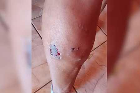 Idosa fica ferida após ser mordida por cão do vizinho em cidade do interior de São Paulo