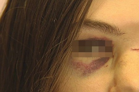 Motorista em Rio Preto quebra rosto de jovem com soco durante acidente