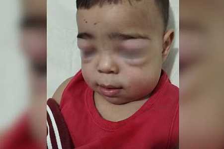 Pais denunciam profissional por colocar sem testar sonda urinária que ficou ´travada´ na bexiga de criança de 2 anos