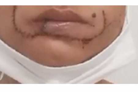 Mulher perde metade do lábio ao ser mordida pelo ex, no interior de SP