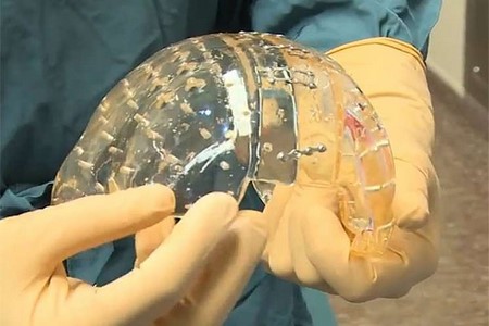 Médicos trocam crânio de mulher por prótese de plástico impressa em 3D